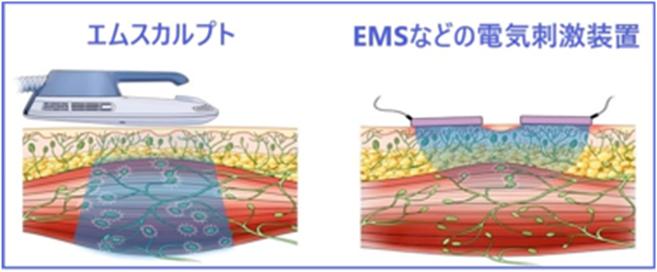 エムスカルプト（EMSCULPT）と電気刺激装置の比較
