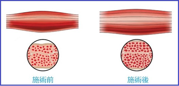 エムスカルプト（EMSCULPT）施術前と施術後